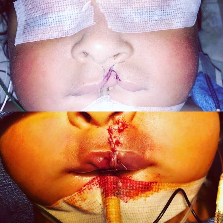 cleft-lip-before-after